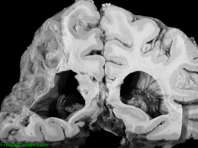 Organizing Infarct, coronal section through parietal lobes.